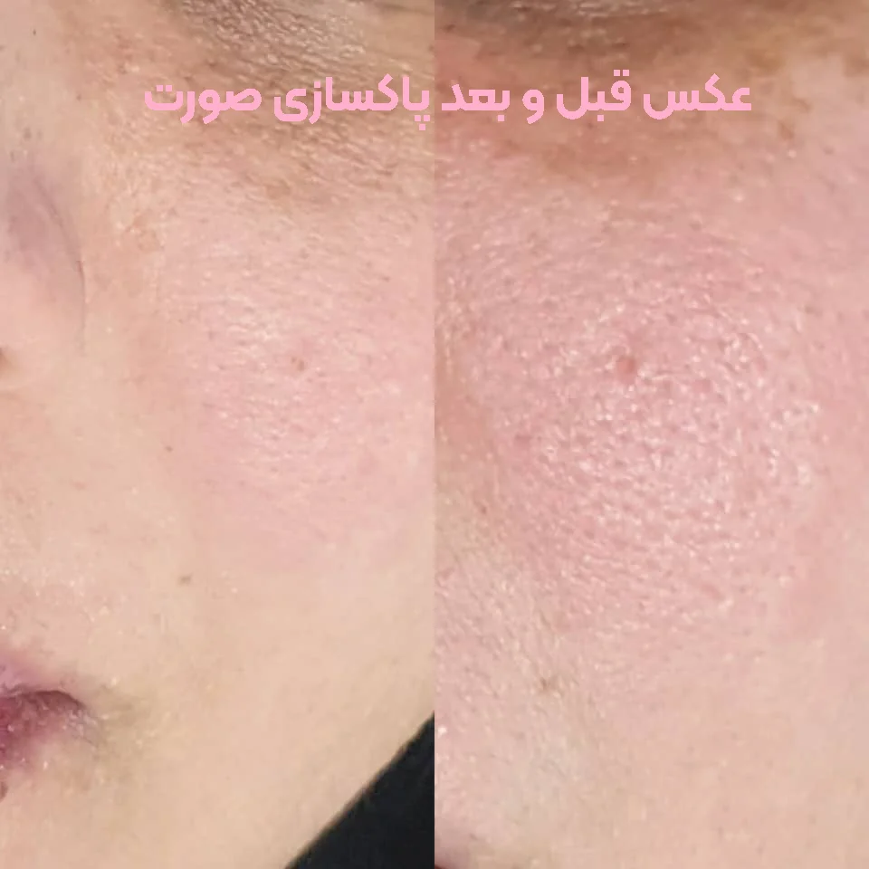 عکس قبل و بعد پاکسازی صورت