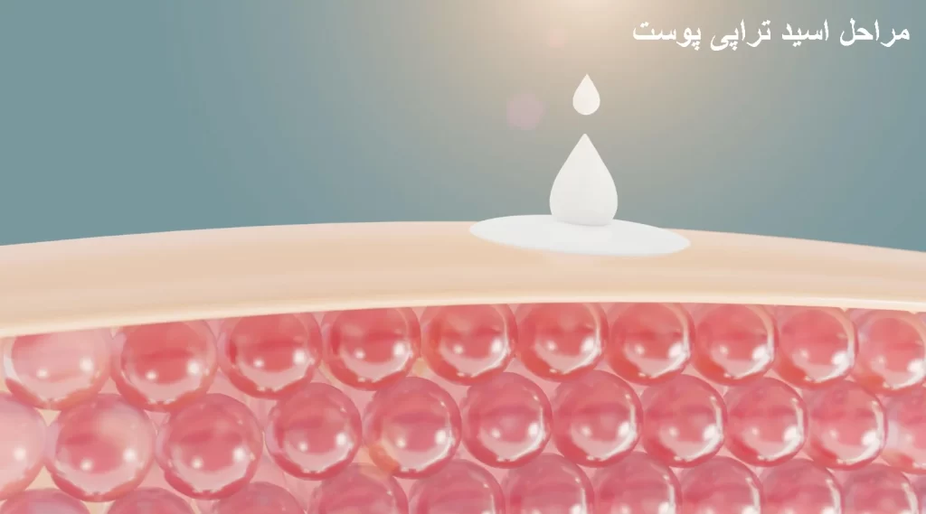 مراحل اسید تراپی پوست