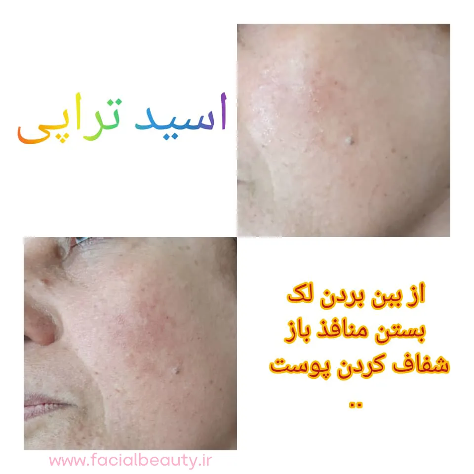 فواید اسید تراپی